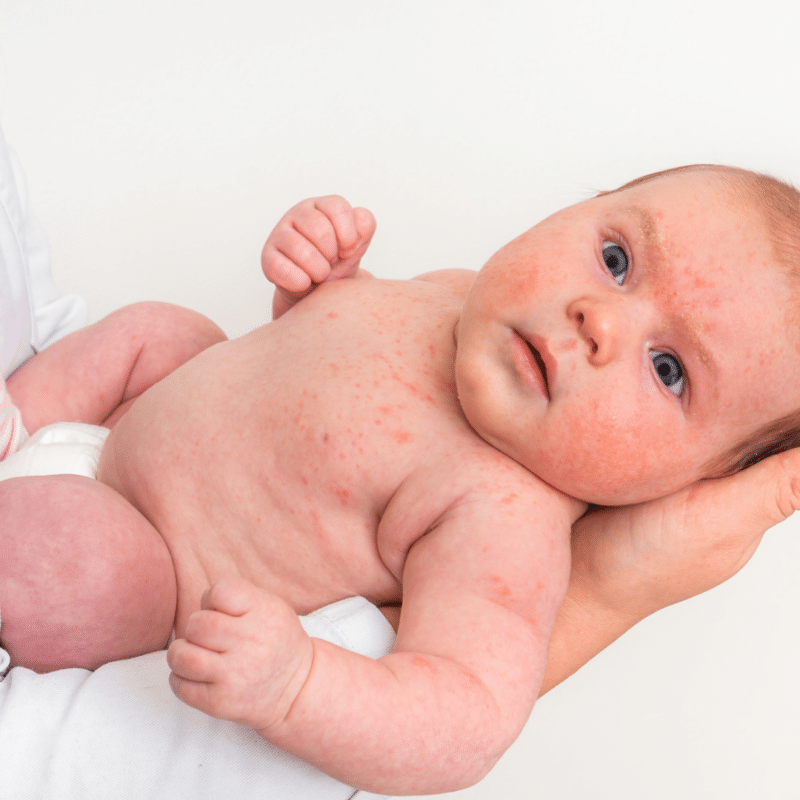 Infants with Eczema
